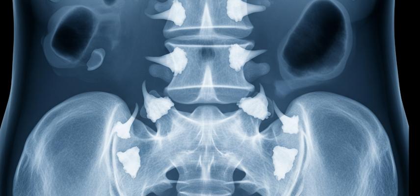 Спондилоартроз: що це, симптоми та ефективне лікування